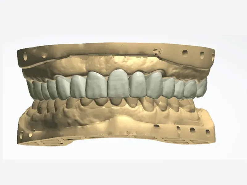 Modélisation-Numérique-De-Prothèses-Avec-Le-3-Shape-En-Haute-Loire (1)
